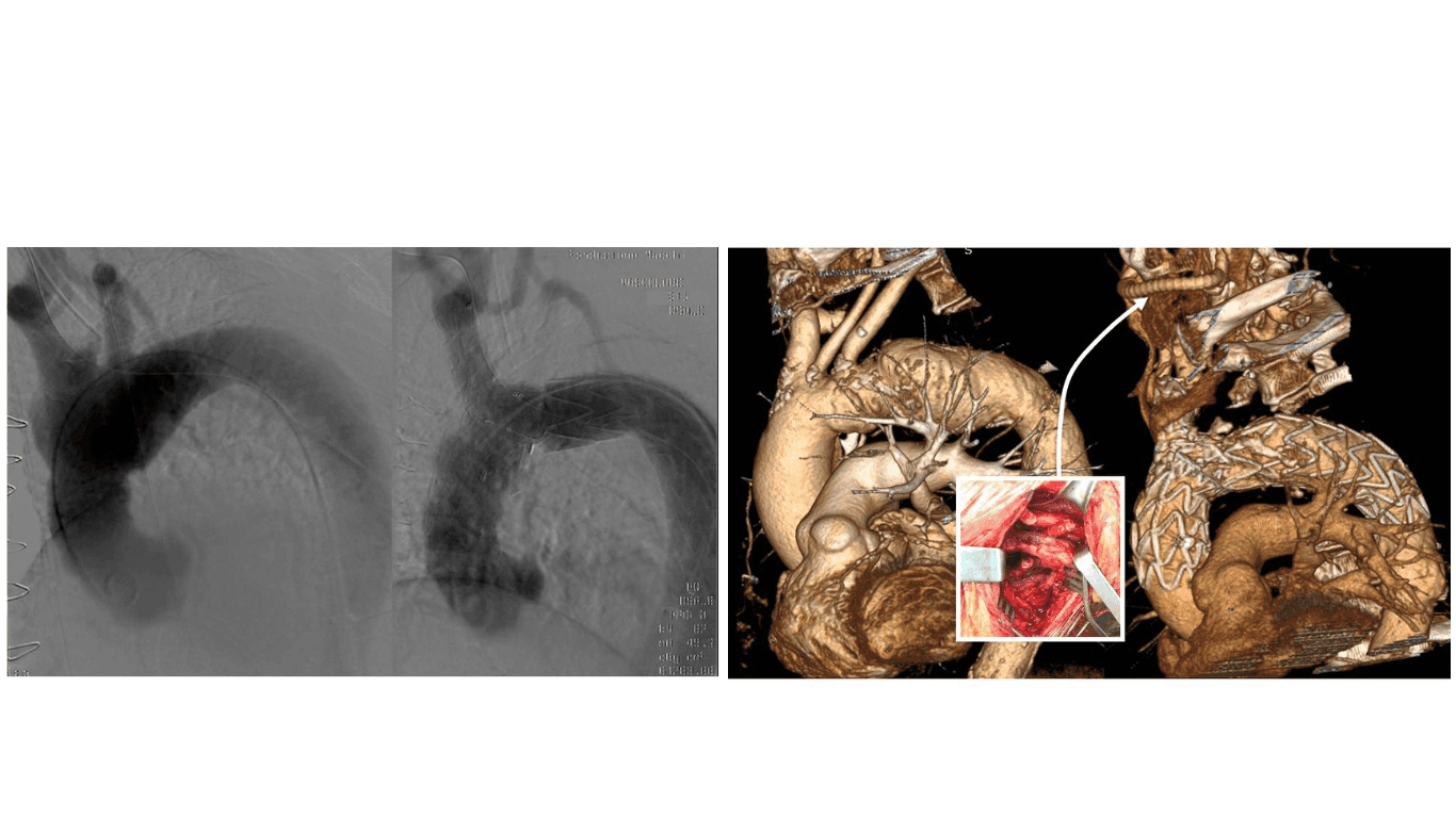 La Chirurgia vascolare varesina nel ristretto gruppo di chirurgie vascolari in Italia ad impiantare un'endoprotesi ramificata per il trattamento della patologia dell’aorta ascendente ed arco aortico.